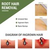 Tulatouzi Ingrown Hair Treatment,Ingrown Hair Patch,Razor Bump Treatment for Bikini Area,30 Patches,Quickly and Effectively Clear Up Ingrown Hair Bumps Patch Smooth-Feeling,Non-Irritating Formula Unisex