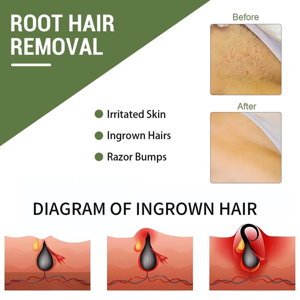 Tulatouzi Ingrown Hair Treatment,Ingrown Hair Patch,Razor Bump Treatment for Bikini