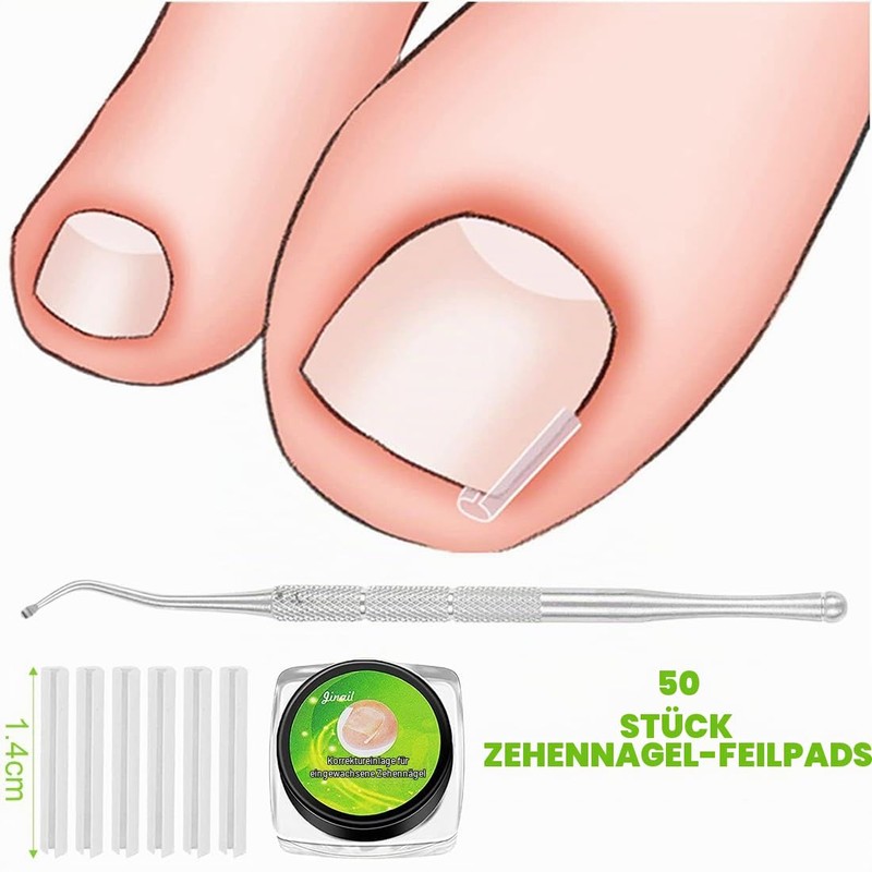 50 Pieces Nail Clips Set for Correction Ingrown Toenails, Toenail