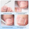 LUSCOR Kit Para Uñas Enterradas,Professional Ingrown Toenail Set,Pegatinas Para Uñas,