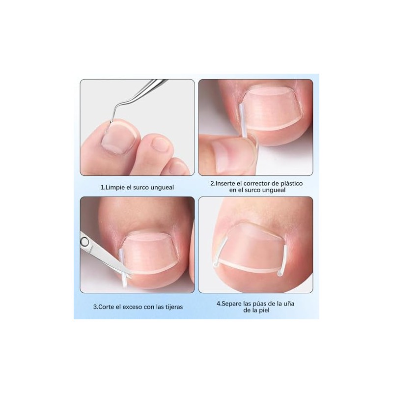 LUSCOR Kit Para Uñas Enterradas,Professional Ingrown Toenail Set,Pegatinas Para Uñas,