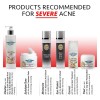 El Peróxido De Benzoilo Al 10% Acné Severo Cleanser- Clínica