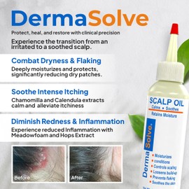 Dermasolve Psoriasis & Dandruff Oil, Dermatologist Approved for Flaky Scalp Relief