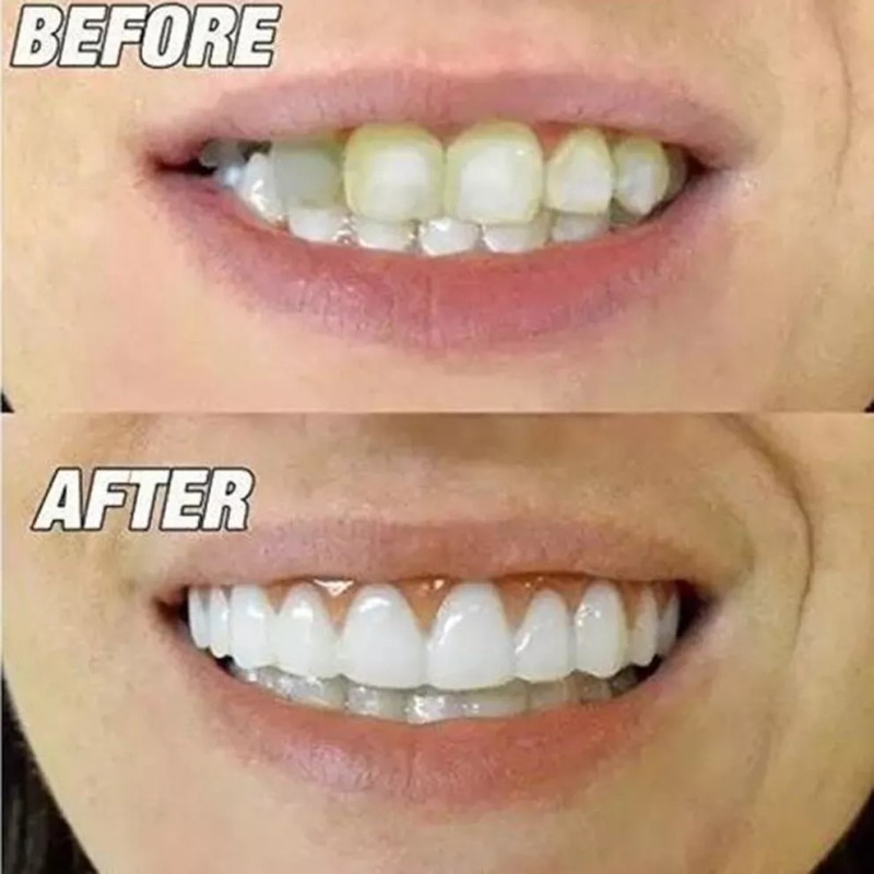 Hikvison 1 Piezas De Dentaduras Profesionales De Silicona Brillante