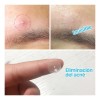 Parches Faciales Antiacné Universo en Linea Hipoalergénicos 25 Piezas