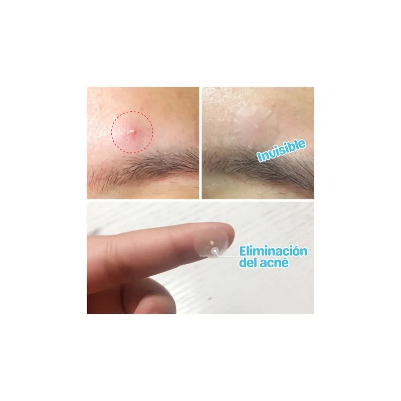 Parches Faciales Antiacné Universo en Linea Hipoalergénicos 25 Piezas