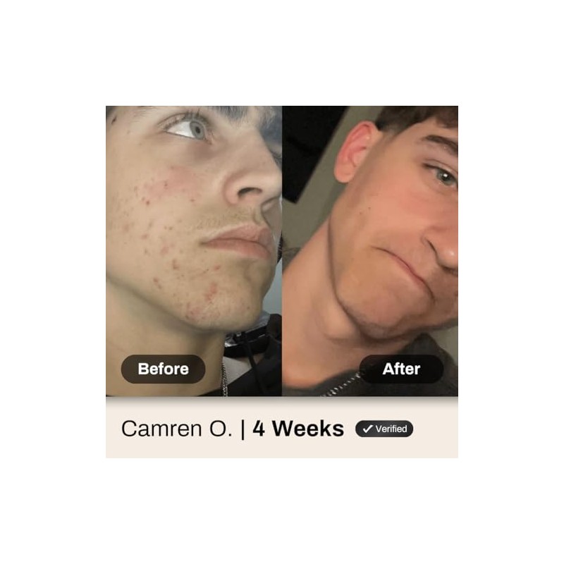 Shield System, Acne System for Men, Face Wash, Moisturizer, Pimple