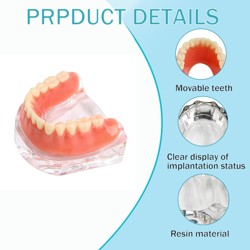 Dental Model Overdenture Transparent Dental Implants Model Detachable Model Lower