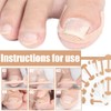Pack of 30 Ingrown Correction Stickers, Toenail Correction Patch, Ingrown