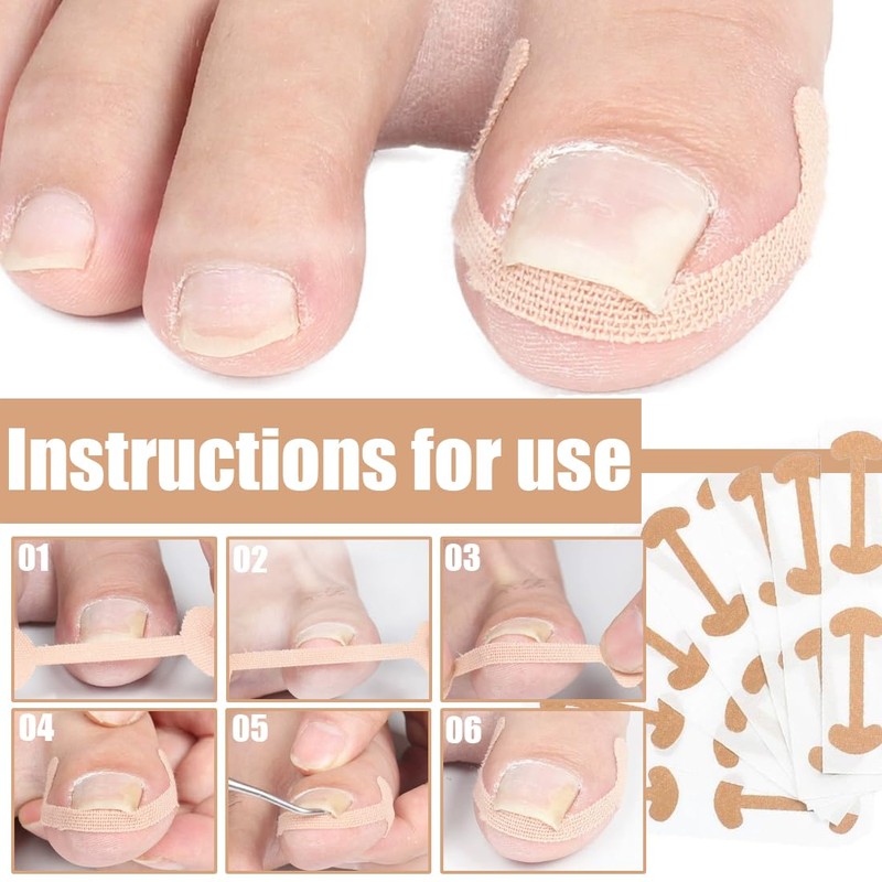 Pack of 30 Ingrown Correction Stickers, Toenail Correction Patch, Ingrown