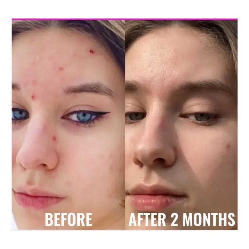 Cleanance Avene Hydra 40ml Tipo de piel Normal