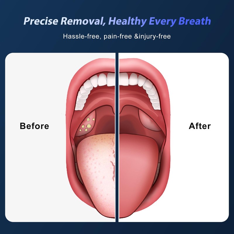 Electric Tonsil Stone Remover Vacuum USB Rechargeable, 6 Suction Levels