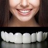 Adjustable Smile Supports - 2 Pairs (Top & Bottom) |