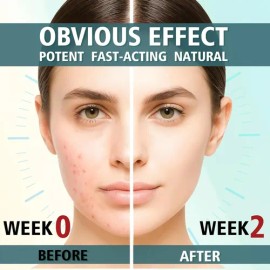 Tratamiento Para El Acné Facial, Crema Antiacné, Crema Para