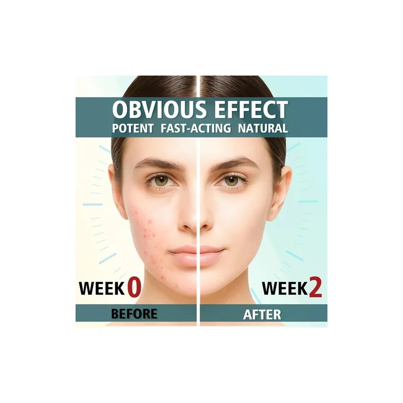 Tratamiento Para El Acné Facial, Crema Antiacné, Crema Para