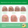 Parches Antimicóticos For El Tratamiento De Uñas