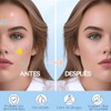 200 SimplePatch Parches Estrella Star Anti Acne Elimina Espinillas, Granos,