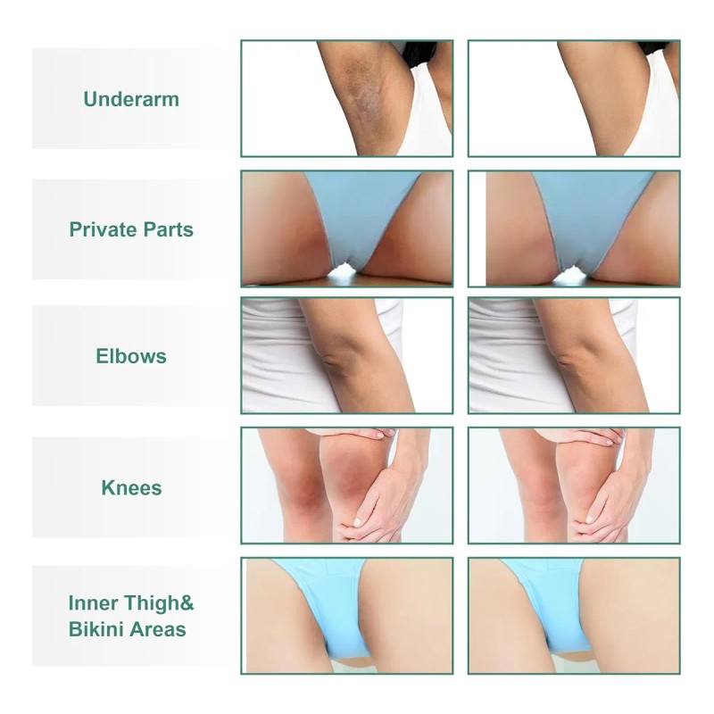 Crema Blanqueadora Para Aclarar La Piel De Las Zonas Íntimas