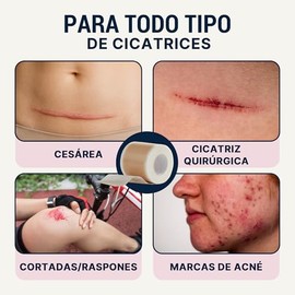 Over Lu DermaSilk™ | Cinta de Silicona para Cicatrices – Parches de Silicona Reutilizables para Cicatrices Quirúrgicas, Cesárea, Acné y Estrías – Grad