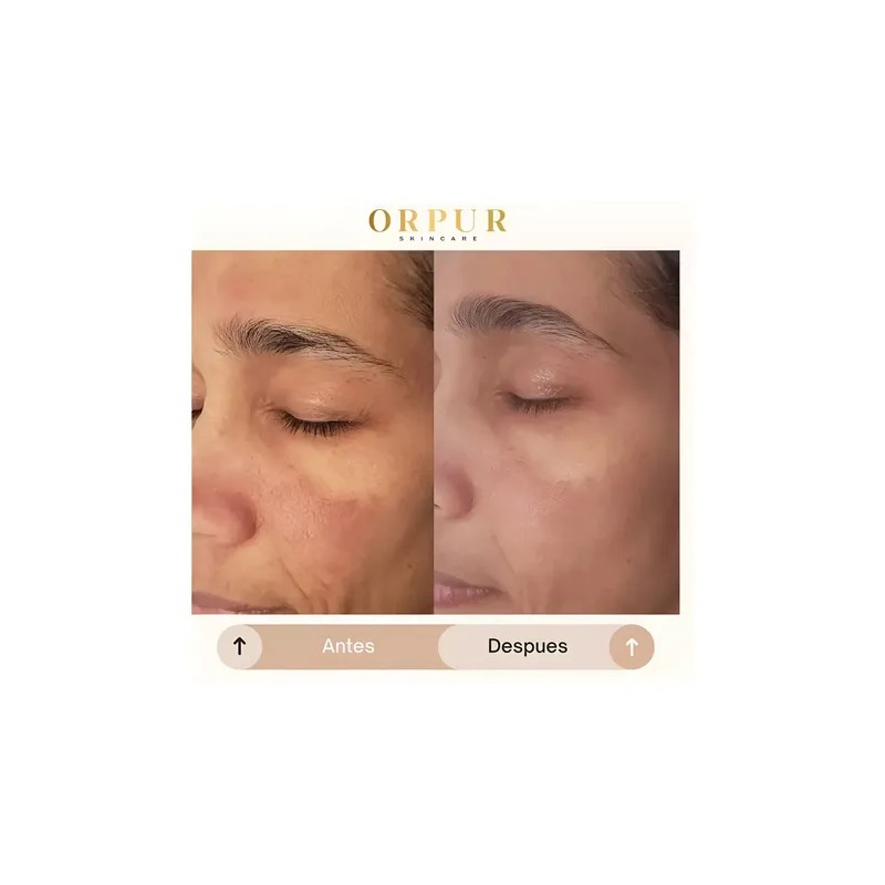 Crema Facial Hidratante Dermoaclaradora Anti Acne 4 Pack