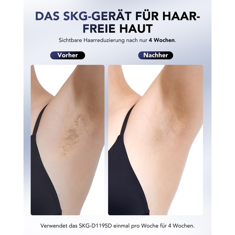 SKG Laser Hair Removal Device