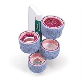 GPI Anatomicals - 4-Piece Vein Model, Replica of a Vein with Blood Clot for Human Anatomy and Physiology Education, Anatomy Model for Doctor's Offices and Classrooms, Medical Learning Resources