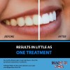 Teeth Whitening Gel 45% Peroxide – 10 Syringe Dental Whitening