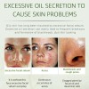Crema Facial Para Eliminar El Acné, Ingredientes Naturales E