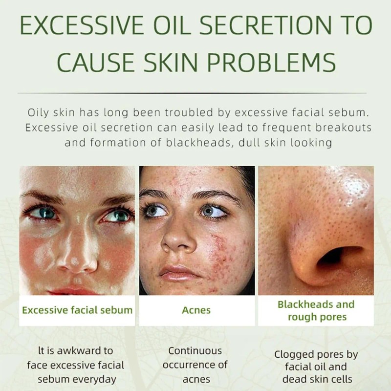 Crema Facial Para Eliminar El Acné, Ingredientes Naturales E