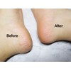 Nella heel callus removal foot cream, 2 foot file set
