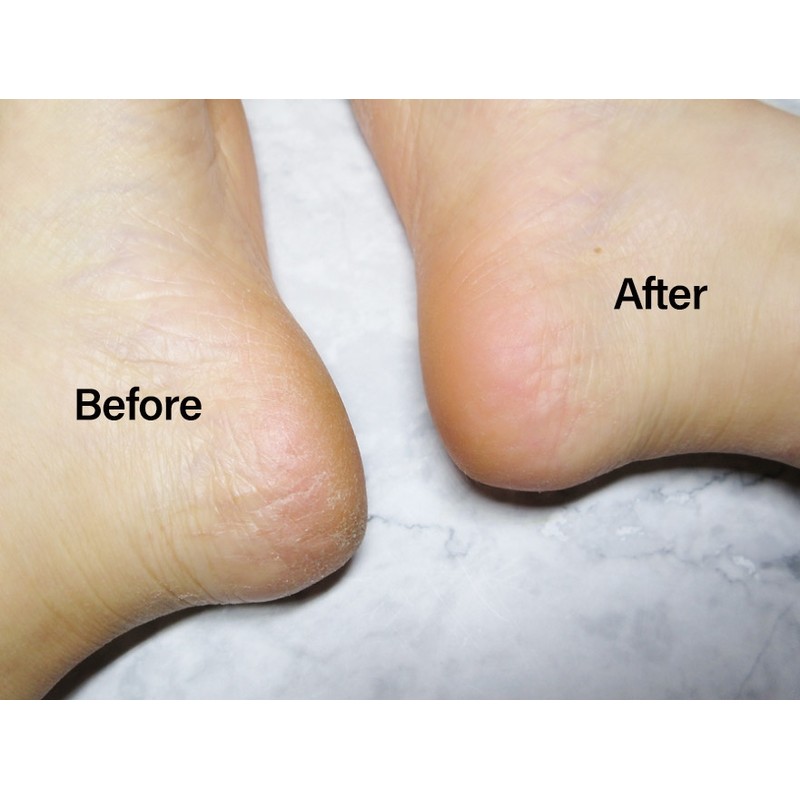 Nella heel callus removal foot cream, 2 foot file set