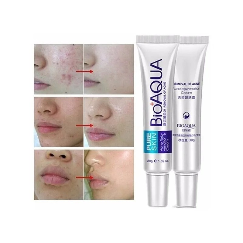 Crema Pure Skin Antiacné Controla Grasa Brotes 30g