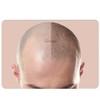 3PCS/Pack Scalp Micropigmentation Practice Skin – Printed SMP Tattoo Training