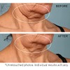 StriVectin, Crema para Cuello para apretar y levantar, 30 ml