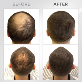 THICK FIBER Hair Fibers for Thinning Hair & Bald spots (DARK BROWN) - 25g Bottle - Conceals Hair Loss in Seconds - Hair Powder for Women & Men