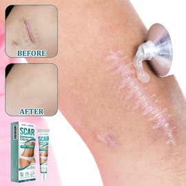 Scar Ointment After Surgery Scar Gel Scar Cream Scar Cream Scar Gel Scar Ointment After Surgery Scar Gel Scar Cream Scar Cream Scar Gel for Body Face Stretch Marks Pack of 4