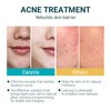 Cerave Acne Control Cleanser Facial Cleanser For Pimple Remover 237ML