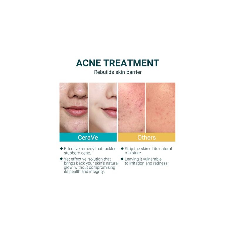 Cerave Acne Control Cleanser Facial Cleanser For Pimple Remover 237ML