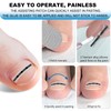 Treatment for Ingrown Toenails with Titanium Alloy and Toenail Ingrown