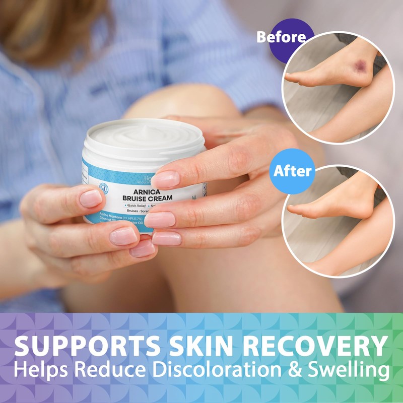 Arnica Cream for Bruising and Swelling: Arnica with Vitamin K,