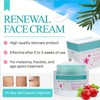 Skin Renewal Face Cream, Melasma Cream, Pigmentation Removal Cream For