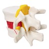 Human Herniated Disc Model, Anatomical Herniated Lumbar Vertebrae Disc Prolapse