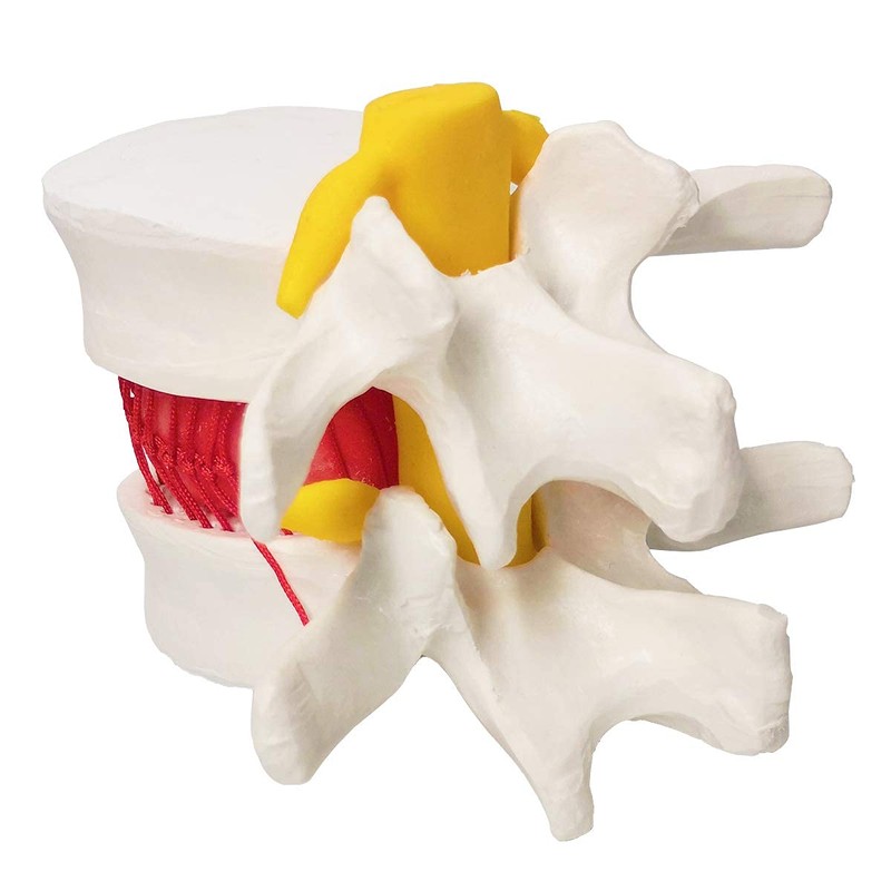 Human Herniated Disc Model, Anatomical Herniated Lumbar Vertebrae Disc Prolapse