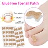 Ingrown Stickers, Corrector Pedicure Tools, Toenail Patch, Ingrown Toenails, Ingrown