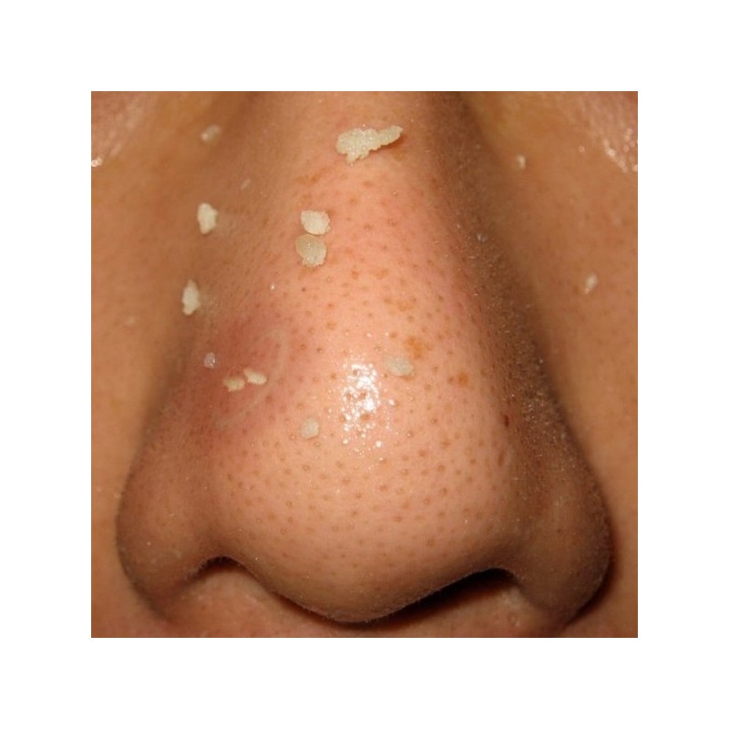 피지제거기 피지흡입기 블랙헤드제거 압출기 얼굴 코 Pore Remover Pore Suction