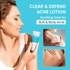Butt Acne Clearing Treatment Cream: Clears & Prevents Breakouts Fast