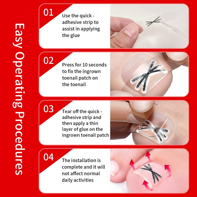 Upgraded Titanium Alloy Ingrown Toenail Corrector with Upgraded 6-Angle Shape,3x
