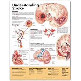 Understanding Stroke Anatomical Chart