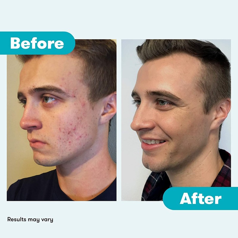 Proactiv Acne Cleanser - Benzoyl Peroxide Face Wash and Acne