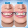 Xumann 400 PCS Orthodontic Elastic Bands, Braces Band for Dentist